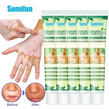 Sumifun 5pcs Médical le Traitement du Vitiligo Crème Enlever Tache Blanche de Promouvoir la Production de Mélanine à base de plantes de la Peau Vitiligo Soins de Santé 20g